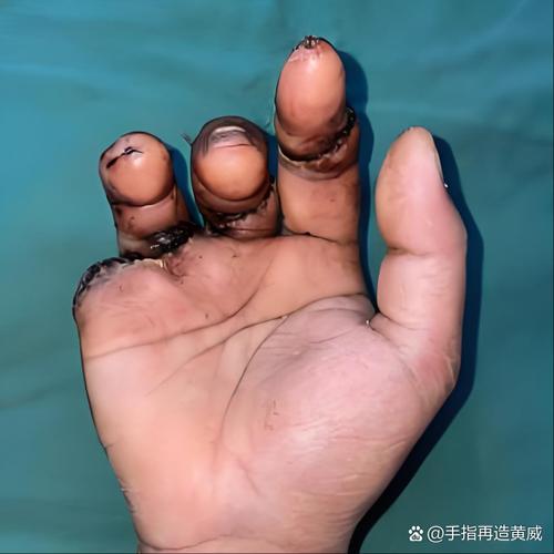 突发！武切维奇仅107秒右手无名指骨折 绿军全明星中锋伤退